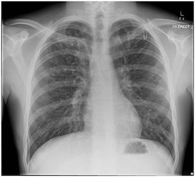 Osteogenic Sarcoma in an Adolescent With Cystic Fibrosis: Successful Treatment Despite Significant Obstacles